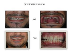 רביעיית שיניים עליונה - ציפוי חרסינה