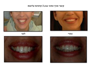 קיצור אורך השיניים על ידי חרסיניה ושינוי צבע